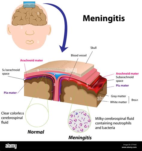 Bacterial Meningitis Hi Res Stock Photography And Images Alamy