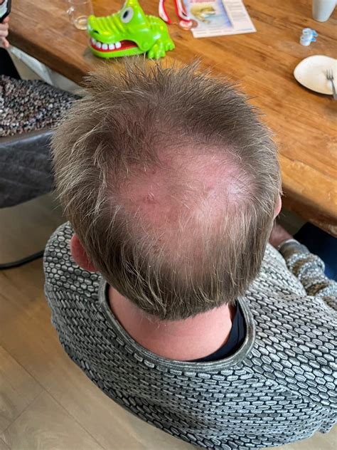 heb je dun haar man  tips die je aantrekkelijker maken
