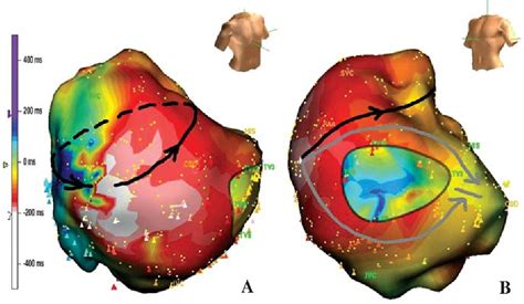 Figure From Electroanatomical Mapping And Ablation Of Upper Loop