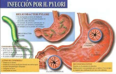 O Que H Pylori Causa - Bacteria Helicobacter Pylori: Síntomas y Tratamiento - ViviendoSanos.com