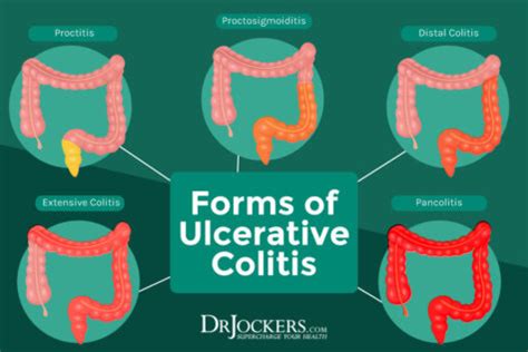 Ulcerative Colitis: Causes, Symptoms and Support Strategies