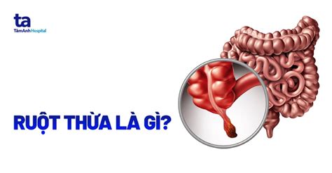 Ruột Thừa Là Gì Nằm Bên Nào Triệu Chứng Và Cách Phòng Ngừa