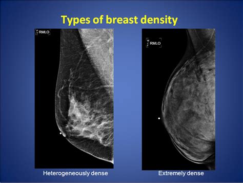 Varying Degrees Of Breast Density