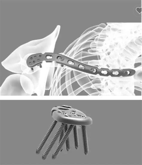 Orthopaedic Implant Titanium Distal Clavicle Locking Plate With Ce