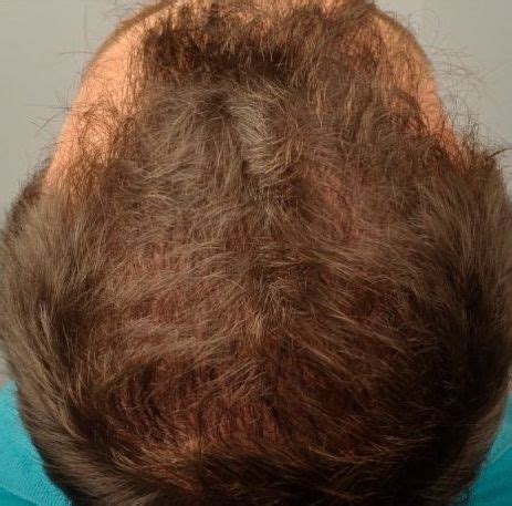 Trapianto Capelli Ad Alta Densit Micro Fue Hd Clinica Pallaoro