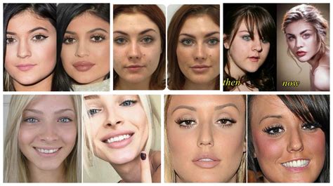 LIP Fillers & Why Is Everyone Getting Them?! - The Fashion Tag Blog