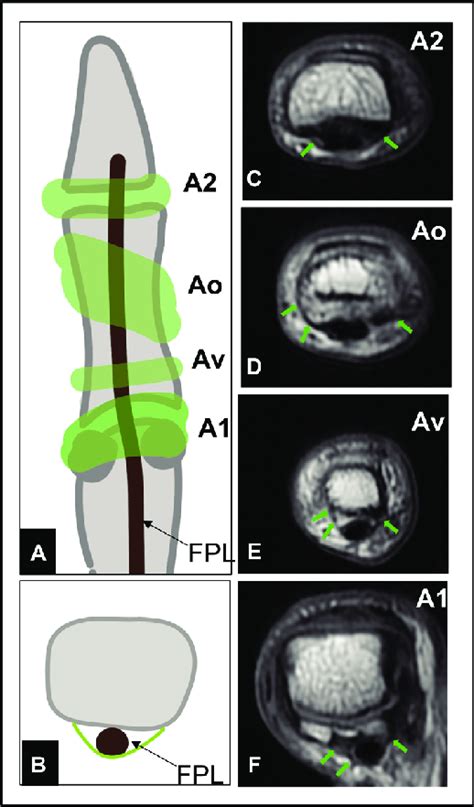 Pulley system around the flexor pollicis longus (FPL) tendon. (A ...