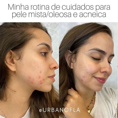 Flavia Urbano on Instagram DIÁRIO DE MANCHAS COMO eu cuido da minha