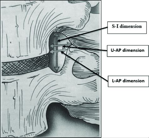 Different dimensions of intervertebral foramen | Download Scientific ...