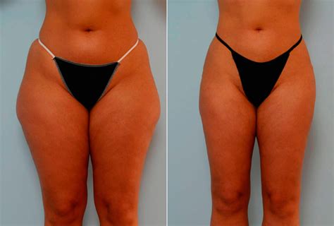 Tummy Tuck Vs Liposuction Cost Breakdown