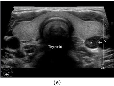 Isthmus Thyroid Ultrasound