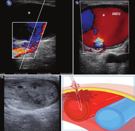 Pseudoaneurysm Groin Ultrasound