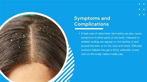 Facts And Causes Of Dandruff Hair Ensure Ppt