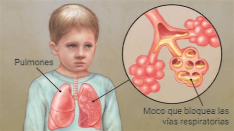 Fibrosis Quística