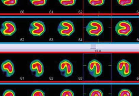 La Scintigraphie Myocardique Quest Ce Que Cest Cardiopole Lyon