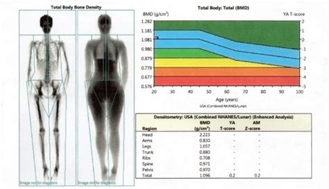 Osteostrong Mobile Hillcrest How To Read Your Dexa Scan Results