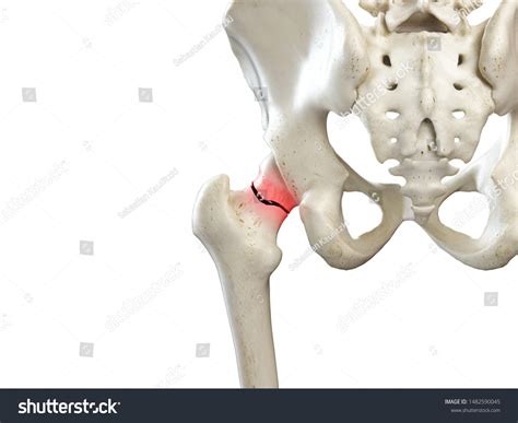 5,615 Fracture femur Images, Stock Photos & Vectors | Shutterstock