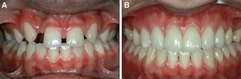 Congenitally Missing Maxillary Lateral Incisors Canine Substitution