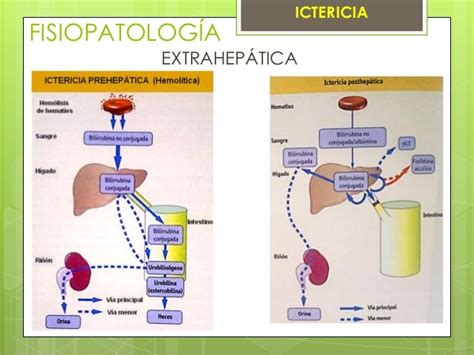 Ictericia