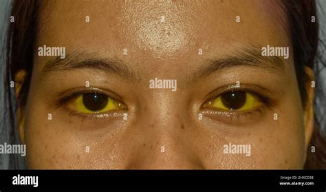 Liver disease yellow eyes skin hi-res stock photography and images - Alamy