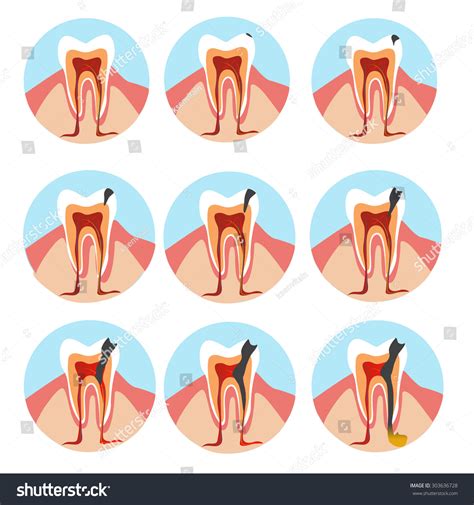 Stages Of Tooth Decay Over Royalty Free Licensable Stock Vectors