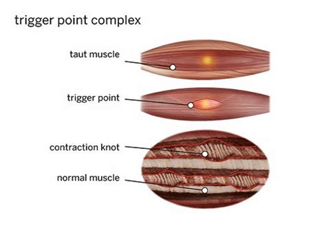 What Is Dry Needling And Is It For Me Pps Physiotherapy