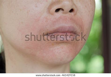 Human Skin Presenting Allergic Reaction Allergic Stock Photo