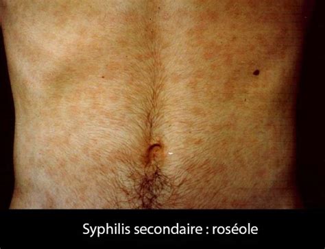 Syphilis Secondaire Dr Kara Zaitri M A