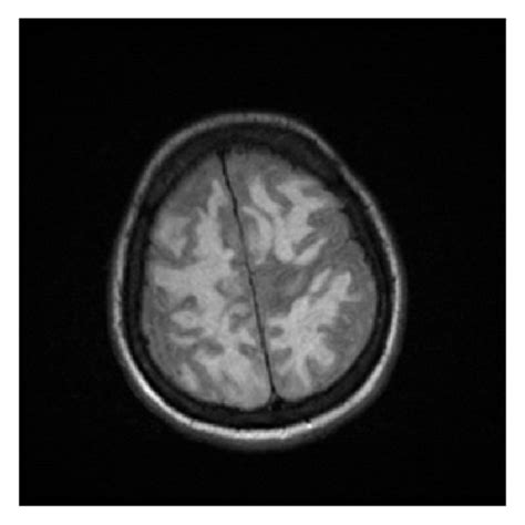 MRI Brain Axial FLAIR Weighted Images Demonstrate The Multifocal Areas