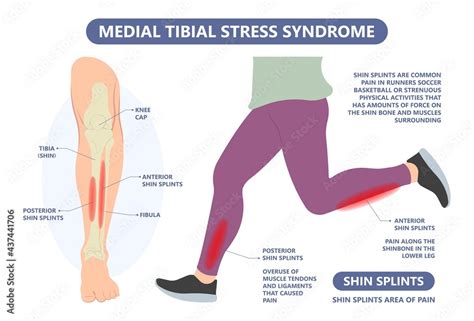 Shin splint leg pain knee injury Sport Lower tibia strain tendon muscle ...