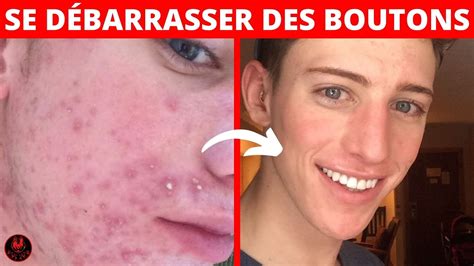 Comment Se D Barrasser Des Boutons Les Meilleures Solutions Youtube