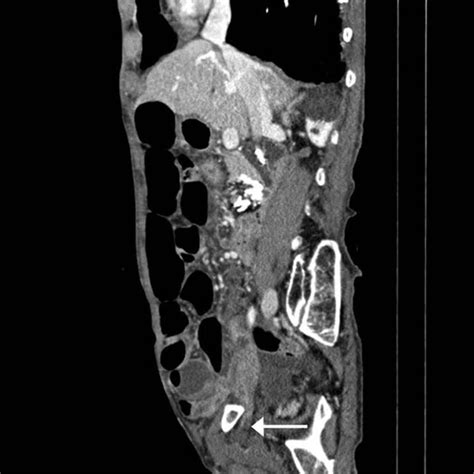 Computed Tomography Of Abdomen And Pelvis Sagittal View Showing Download Scientific Diagram