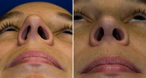 Understanding Inside Crusting After Rhinoplasty A Comprehensive Guide