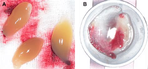 A The Fibrin Clot Was Easily Separated From The Lower Part Of The