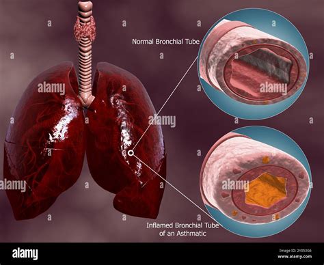 Trachea Cross Section With Lungs Showing Comparison Of Normal And