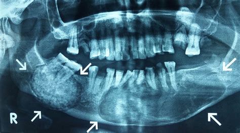 Orthopantomogram Showing A Well Delineated Radiopaque Lesion Associated