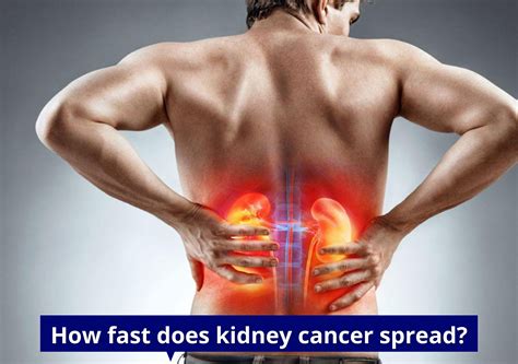 How fast does kidney cancer spread? | UroLife Clinic