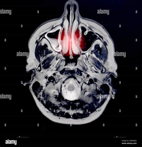 Magnetic Resonance Imaging Of A Patient With Bad Nose Breathing Nasal