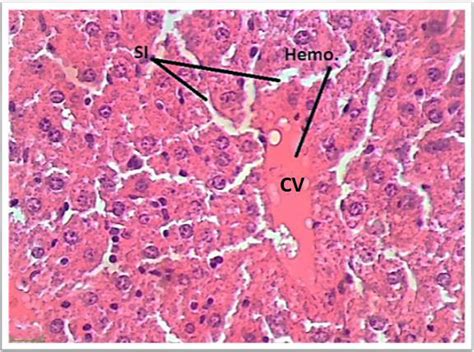 Photomicrograph Of Liver Showing Sinusoid Si And Hemolysis Hemo