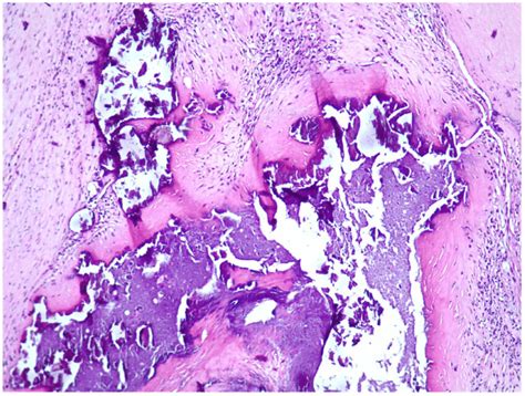 -Dystrophic calcification, fibrinoid necrosis (chronic ulceration) and ...