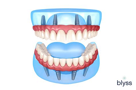 All On 4 Dental Implants Cost Your Guide To Cost Factors