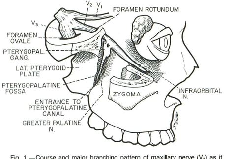 Figure 1 from Pterygopalatine Fossa CT of Perineural Tumor Extension: | Semantic Scholar