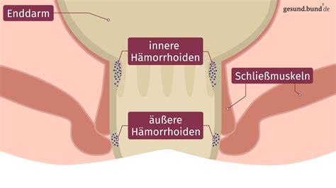 Was sind Hämorrhoiden YouTube