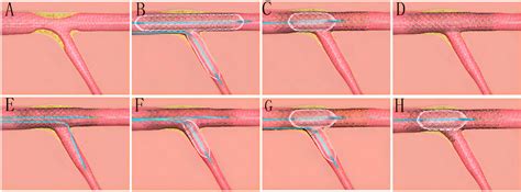 Simple Stenting Strategy With Or Without Branch Ostial Optimization