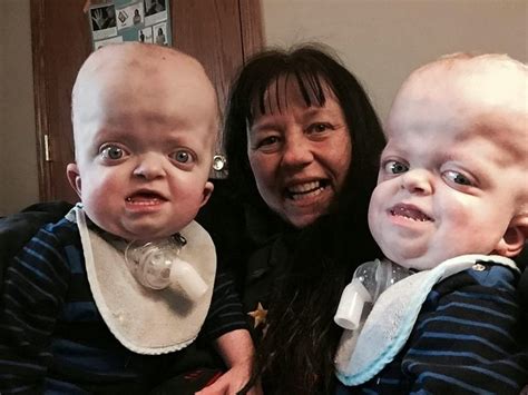 Miracle Mum Adopts Twins With A Rare Genetic Deformity After They Were