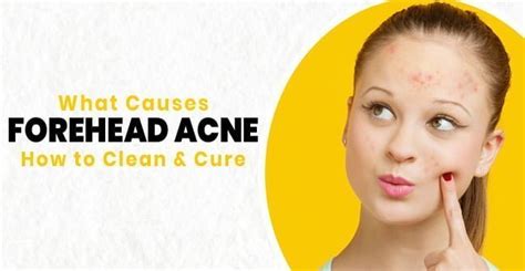 What Causes Forehead Acne- How to Clean & Cure