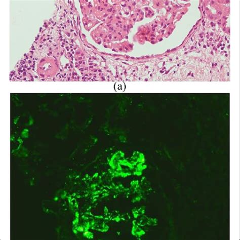 A Light Photomicrograph Showing Glomerulus With Mesangial