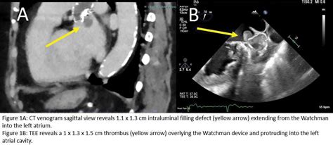 Recurrent Device Related Thrombus After Watchman Implant Journal Of