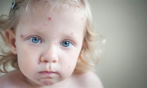 Staph Infection In Babies Pictures PictureMeta