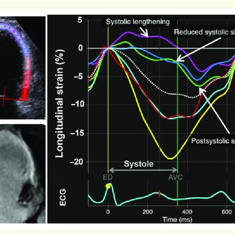 Longitudinal Strain Curves From Apical Four Chamber View In A